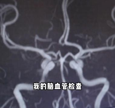 拼盘∕45岁脑梗专家自述“我也脑梗了”　吁警惕这些高危因素