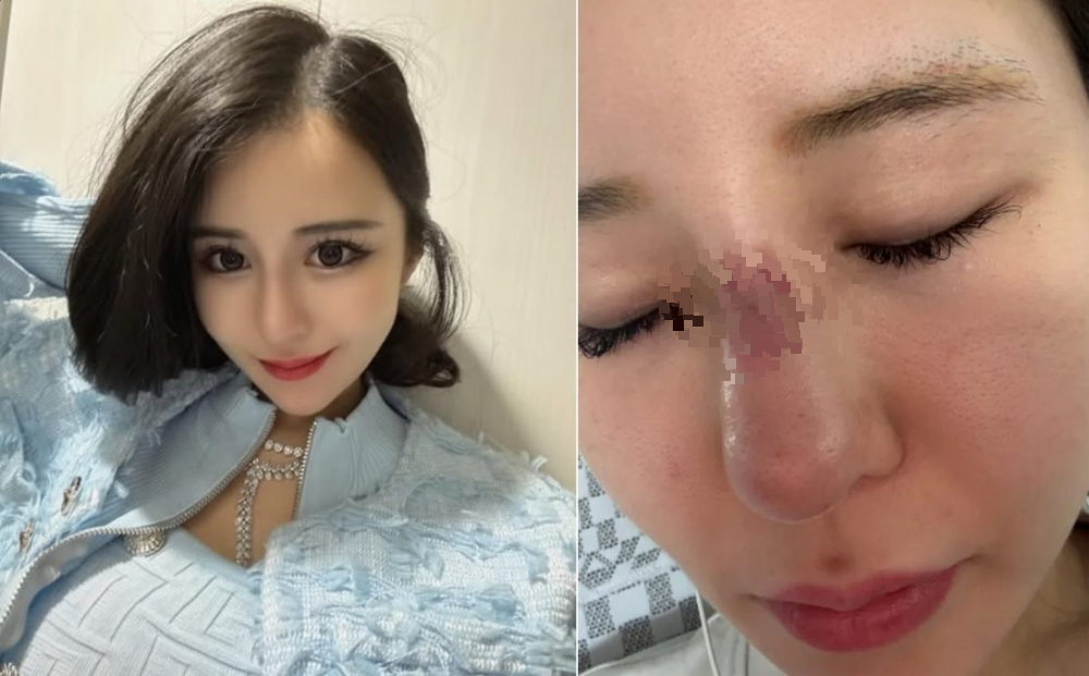 日本网美赴韩整形 鼻樑化脓3个月不敢出门