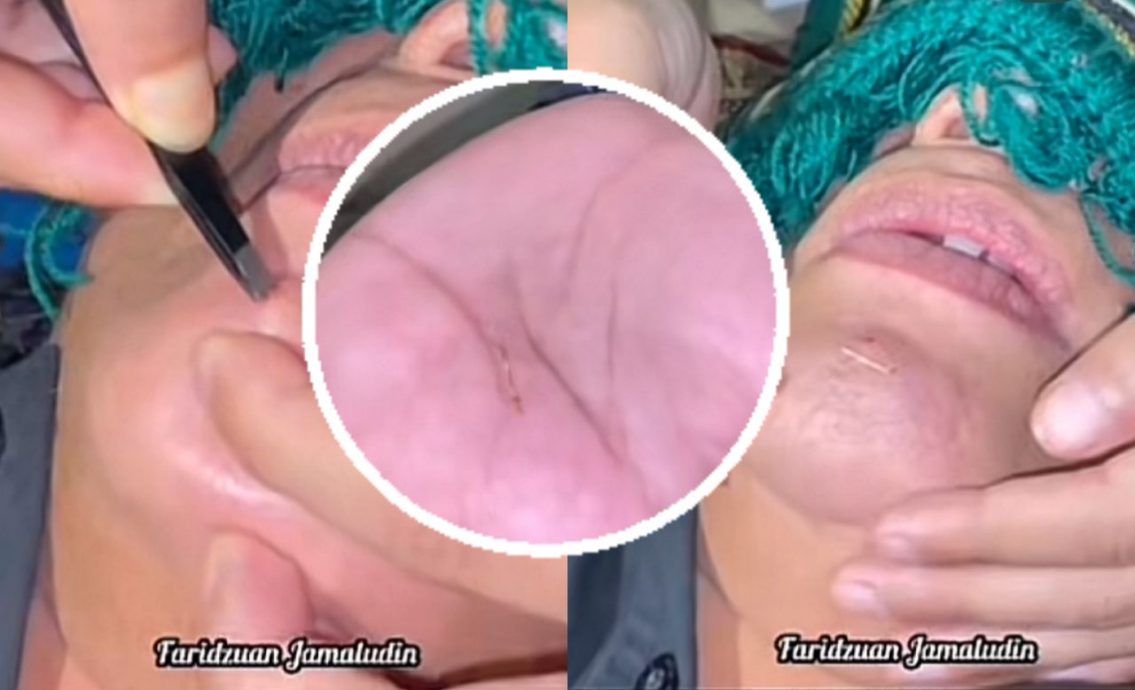 狮城男艺人植“魅力针”数十年 追名利陷精神困境取出针