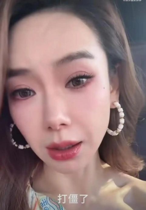 眉毛抬不动认肉毒注射过量 戚薇医美翻车反倒更圈粉