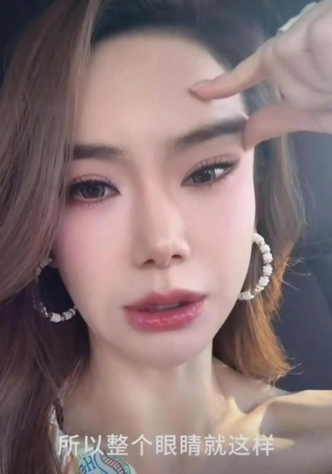 眉毛抬不动认肉毒注射过量 戚薇医美翻车反倒更圈粉