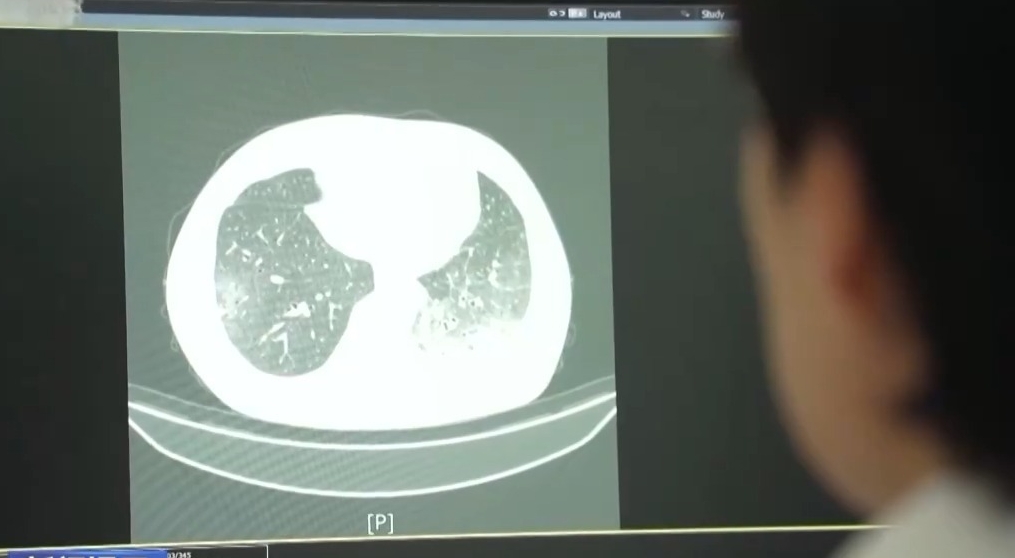 空调吹了一周突然白肺 夏季警惕这个隐匿“杀手”