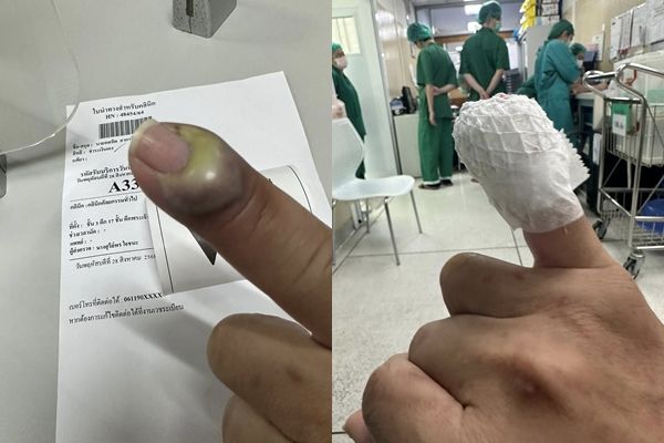 被猫抓伤险截肢！宠物美容师“手指整块化脓”