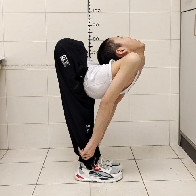 视频/山东“折叠男孩”4次手术“身体扳直全开”　终于能站直看向正前方