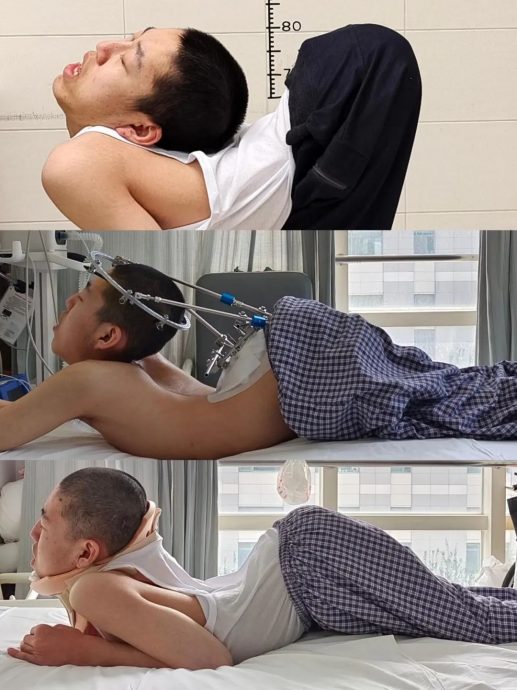 视频/山东“折叠男孩”4次手术“身体扳直全开”　终于能站直看向正前方