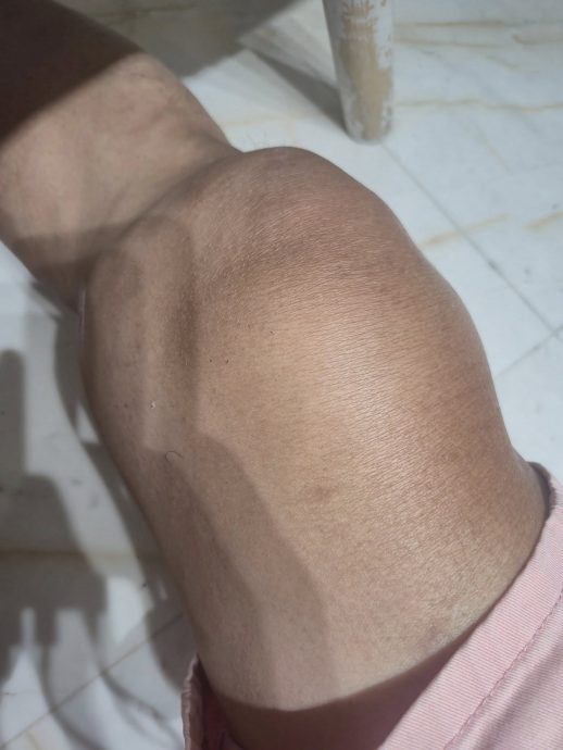 马铃薯叔叔跌倒膝盖内出血 粉丝医生出手相救还承担费用