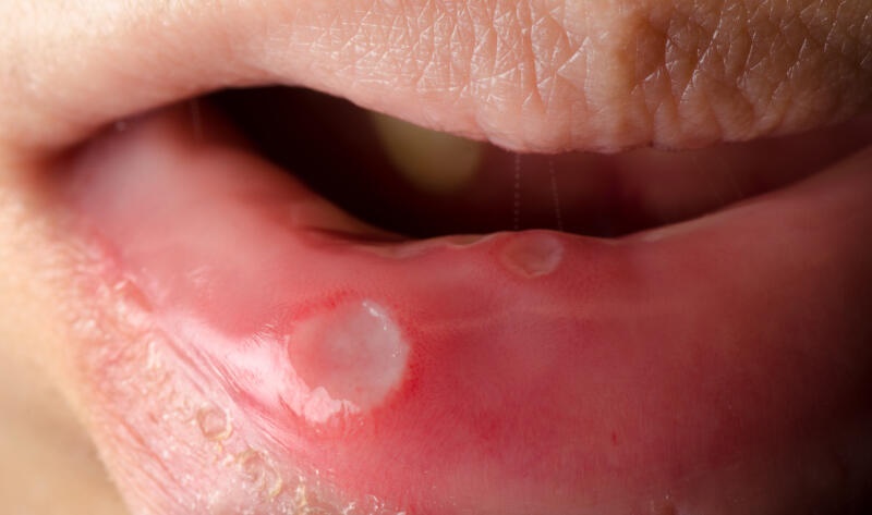 （已签发）柔：狮城二三事：病患服药后脱发口烂住院十天 遭投诉医生吊牌14个月