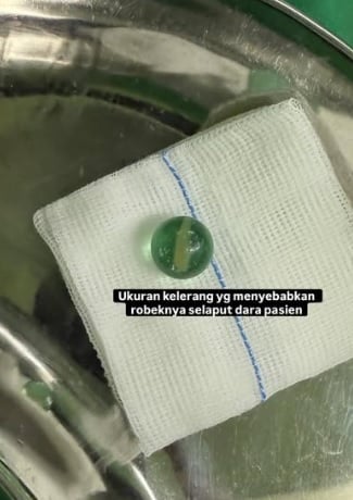 不慎将玻璃弹珠塞阴道 6岁女童术后进行处女膜修复