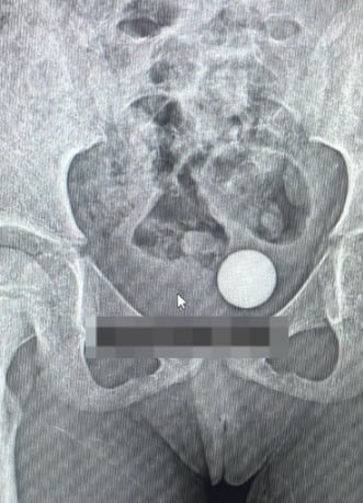 不慎将玻璃弹珠塞阴道 6岁女童术后进行处女膜修复