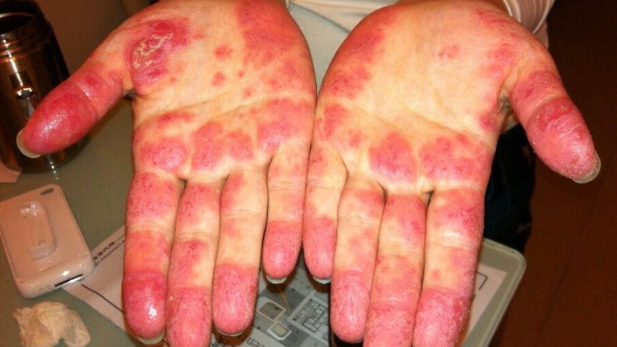 中国科学家发现由单基因导致的红斑狼疮