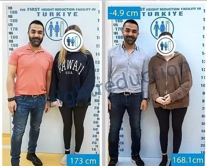 为爱缩腿!土耳其惊现“断骨缩短术” 高妹切骨8.5公分求姻缘