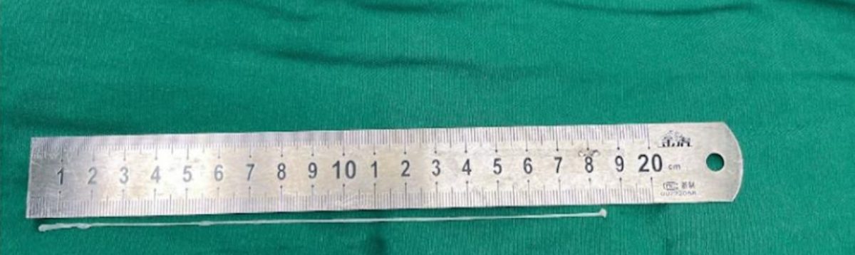 供星洲网：男子视物如有“马赛克” 医生开刀取18cm裂头蚴