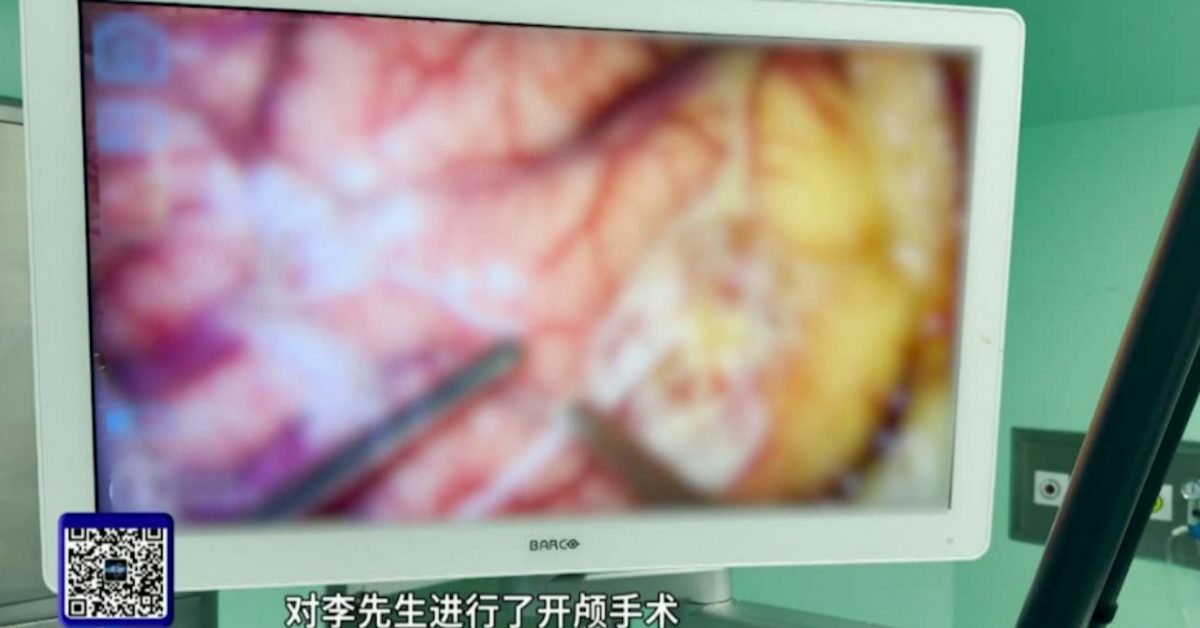 供星洲网：男子视物如有“马赛克” 医生开刀取18cm裂头蚴