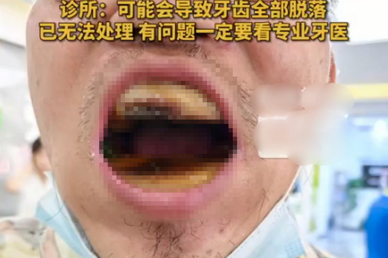 天津男子网购20元材料自行补牙 医生惊呼：口腔长出“烤年糕”