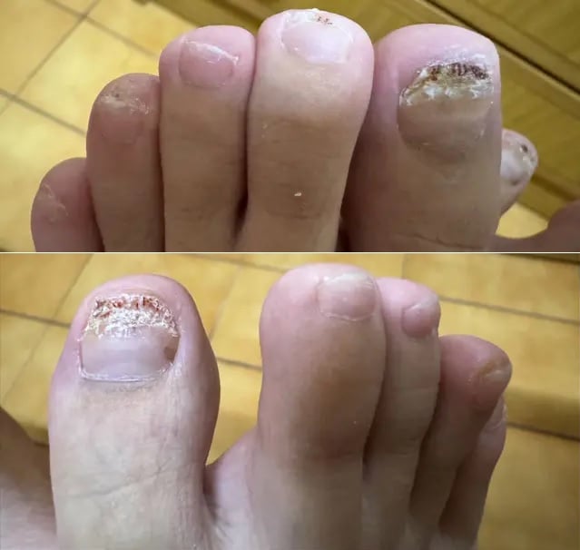 女子做美甲10指皆感染病毒疣 医震惊:第一次看到