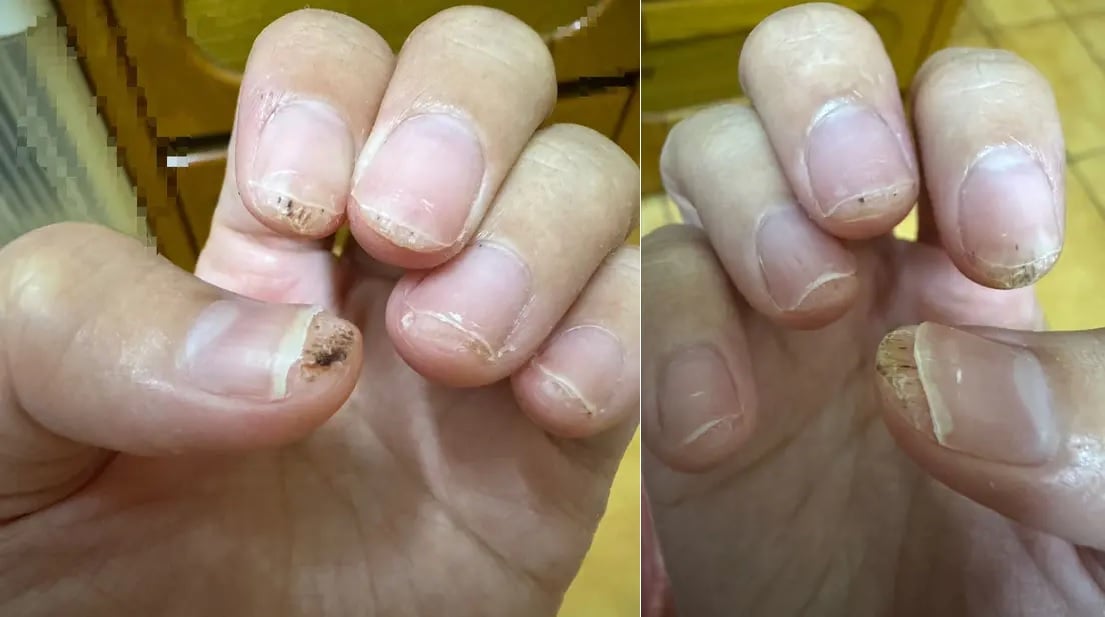 女子做美甲10指皆感染病毒疣 医震惊:第一次看到