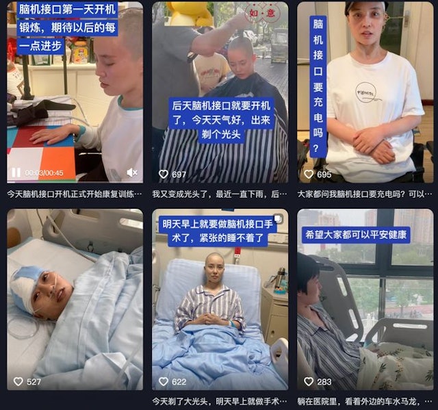 拚盘)女子全身瘫痪6年仅嘴眼能动 接受脑机接口手术以意念抓取物品