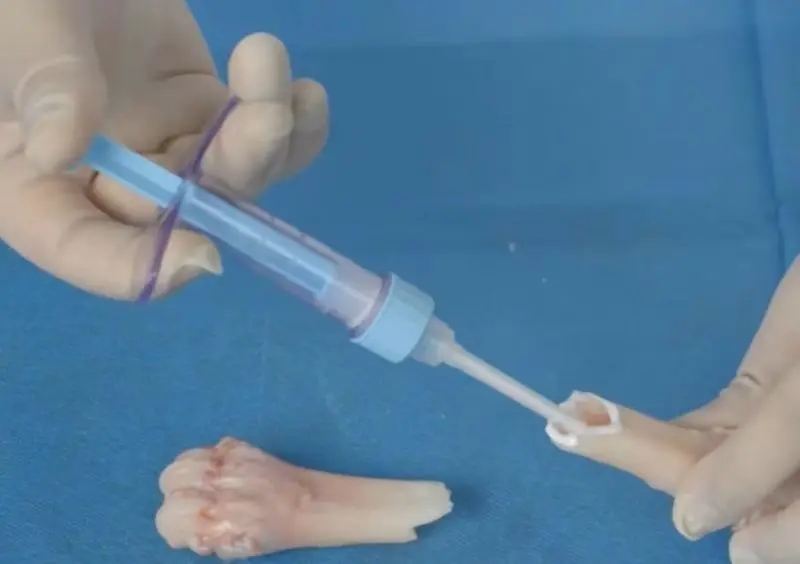 拚盘)浙大附院首创骨胶水 黏合断骨仅需3分钟