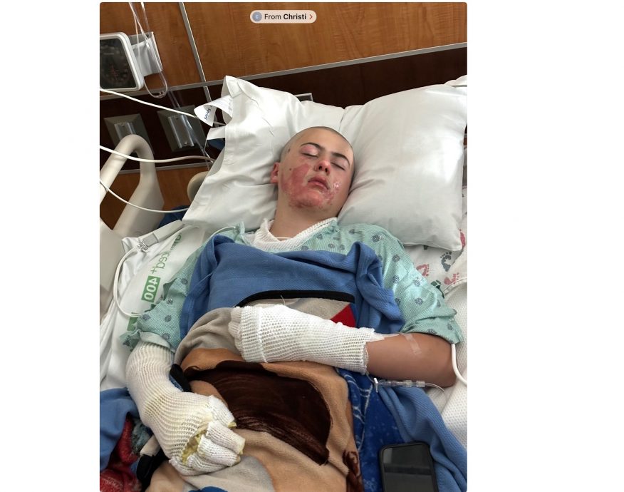 拼盘 美12岁少年TikTok挑战 衣服著火严重烧伤