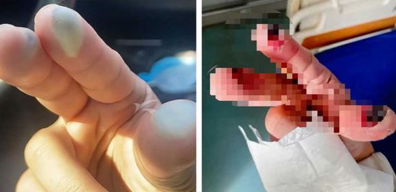 散步误踩“化骨水”容器 女子中毒身亡