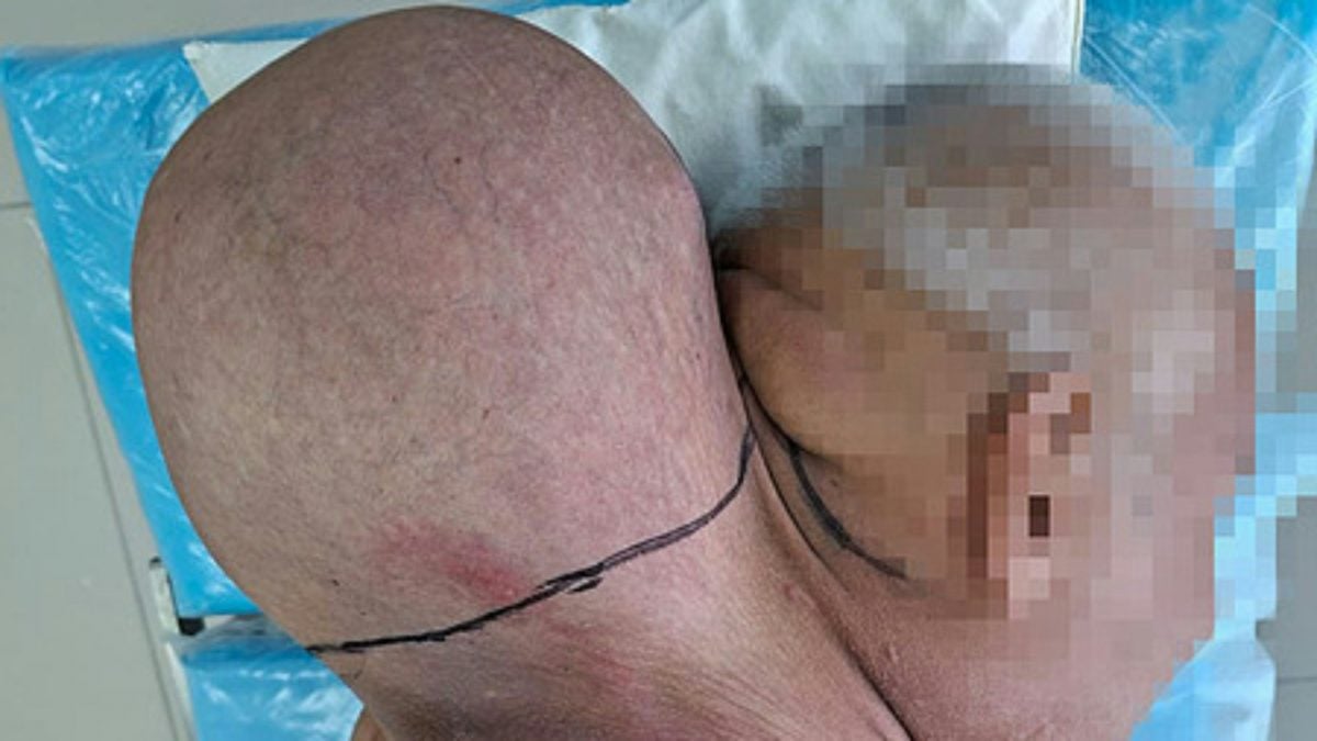 涂药膏16年都无效 俄男颈部肿瘤如头般大