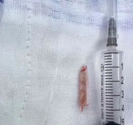 温度计插体内断半截 女子22年后摔脚车才发现