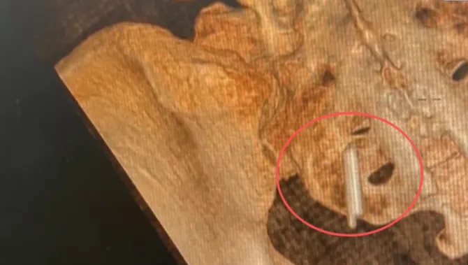 温度计插体内断半截 女子22年后摔脚车才发现