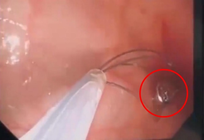 **看世界**误吞纽扣电池  1岁半童食道腐蚀终身残疾