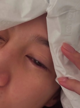 眼角膜伤势恶化痛到入急症 傅嘉莉怕永久影响视力