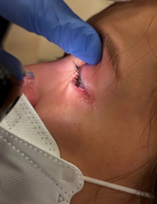 眼角膜伤势恶化痛到入急症 傅嘉莉怕永久影响视力