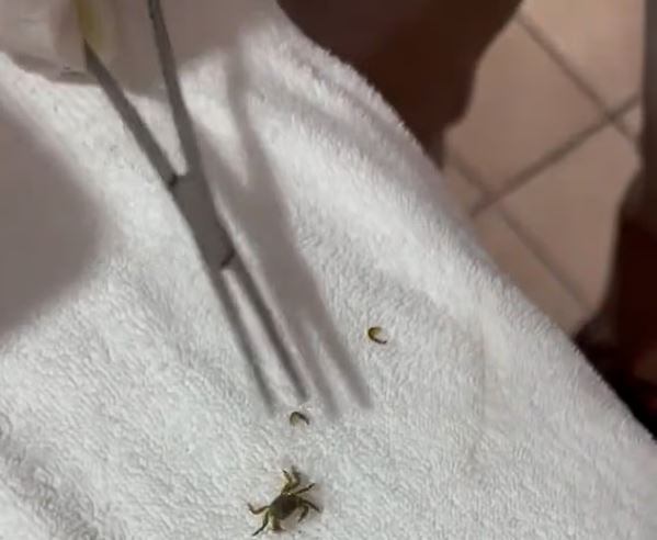 视频／男童耳朵不适  医生夹出一只活螃蟹  