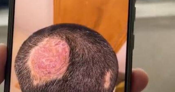 6岁弟头长脓癣永远秃了！元凶竟是“一宠物”　医示警：小孩易感染