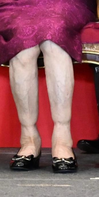 90岁罗兰拄拐杖宣传《金式森林》　双腿浮肿疑静脉曲张