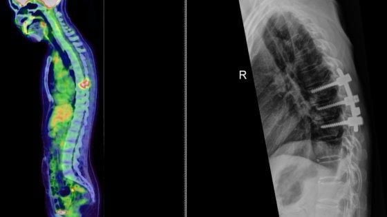 盛晓峰 / 卵巢癌疑转移脊椎 开刀难根治 放化疗标靶更关键