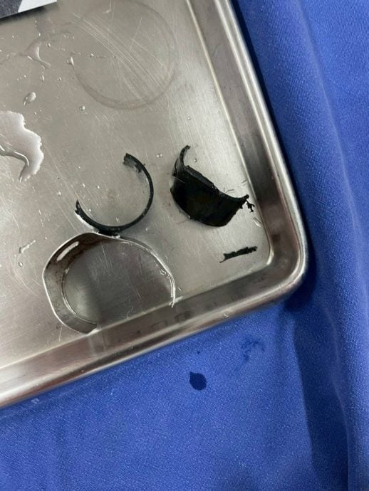 为“防盗”用钢箍锁下体? 泰男生殖器肿胀入院求救