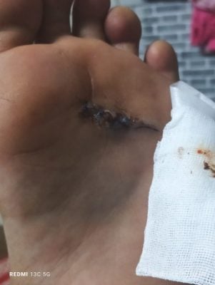 大都会2:河中有玻璃酒瓶 游客割伤缝4针/3图