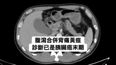 腹泻腰酸别轻忽　男子确诊胰脏癌末期　