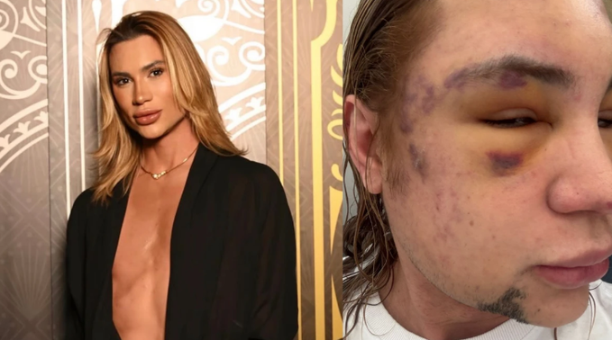 巴西时尚网红整形“狐狸眼”感染猝逝 年仅31