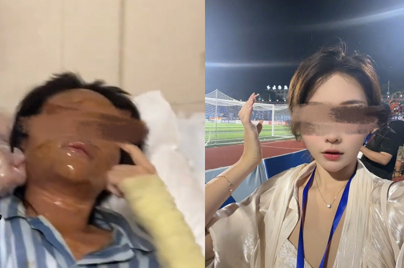 正妹直播主“开包裹爆炸”毁容　双眼肿剩一条线