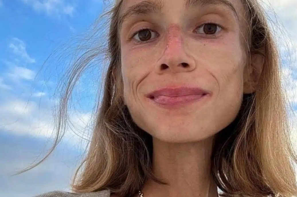 瘦成骷髅只剩22公斤! 素食女“只吃水果”活活饿死