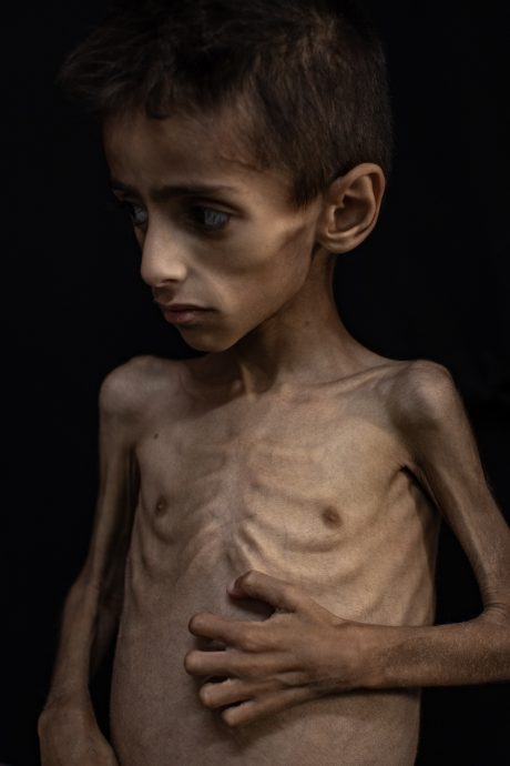 研究：加沙近六分一儿童罹患急性营养不良