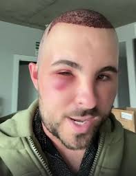 豪砸7.4万植发惨变“蛋头人”?男子术后肿胀照引热议