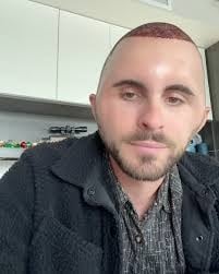 豪砸7.4万植发惨变“蛋头人”?男子术后肿胀照引热议