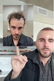 豪砸7.4万植发惨变“蛋头人”?男子术后肿胀照引热议