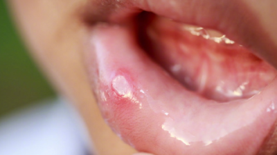 长期口腔溃疡坐视不理 男子患白塞氏症致失明