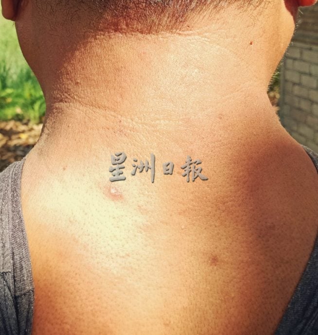 供星洲网:烧焊工友河边垂钓避雨时,被虎头蜂追螫5针