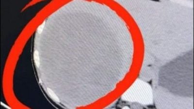 15岁肝脏有巨大恶性肿瘤 医生：与饮食习惯有关