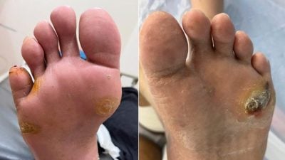 鸡眼与茧并非小问题 糖友更要小心防 长期恐引发感染溃疡