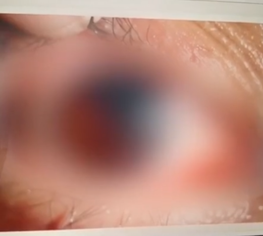 保温杯变“定时炸弹”？女子焖红枣水开盖被炸破眼球