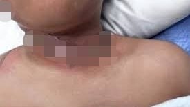 充电线缠项链起火！ 男童脸和颈部烧伤